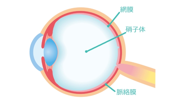 白いもやもやが見える　目