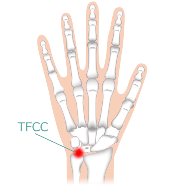 手首　痛い　小指側