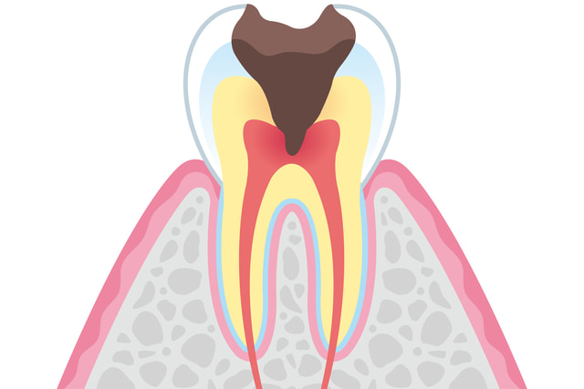 虫歯