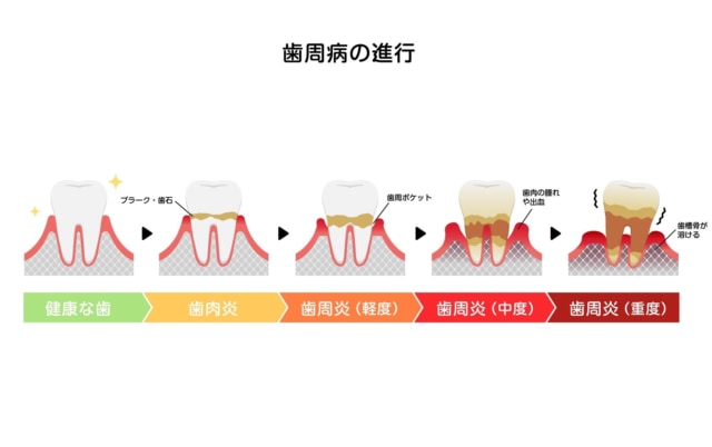 歯周病の進行