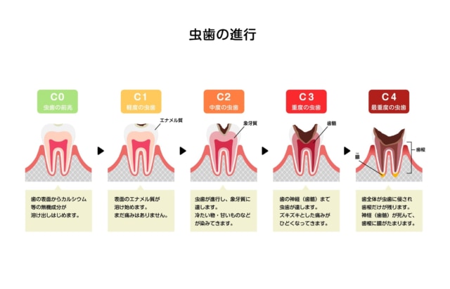 虫歯　進行具合