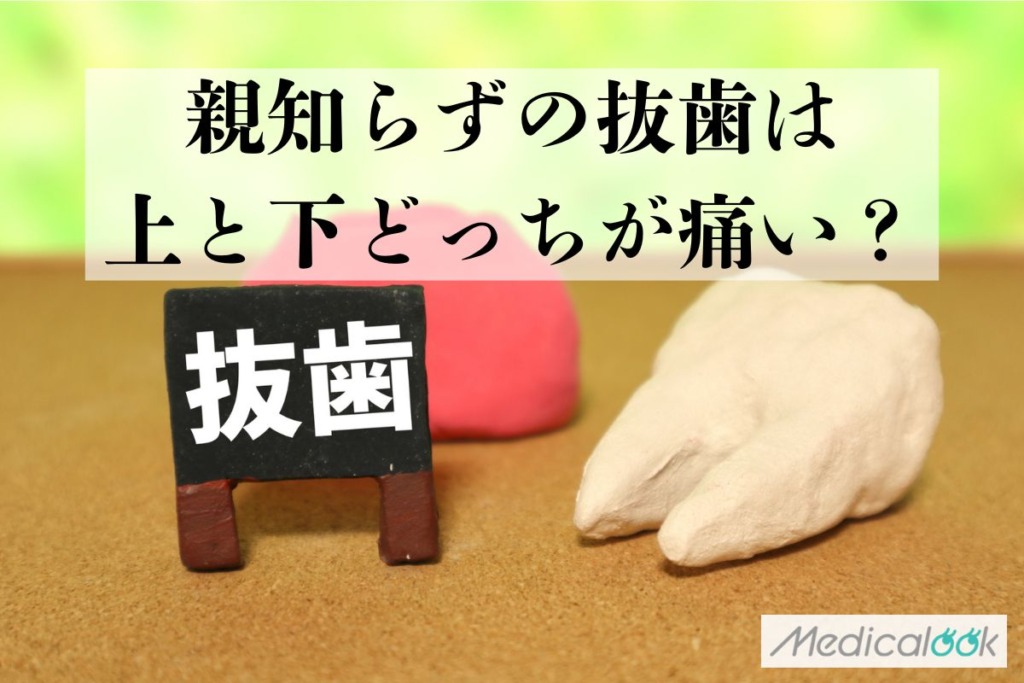 親知らずの抜歯は上と下どっちが痛い？腫れやすいのは？食事はどうする？【歯科医師監修】