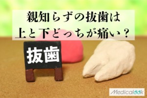 親知らずの抜歯は上と下どっちが痛い？腫れやすいのは？食事はどうする？【歯科医師監修】