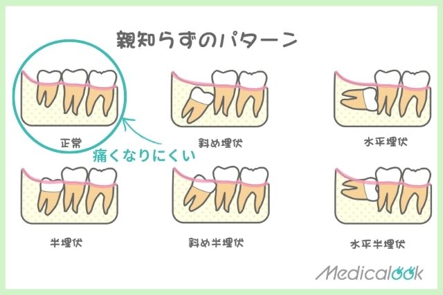親知らずのパターン