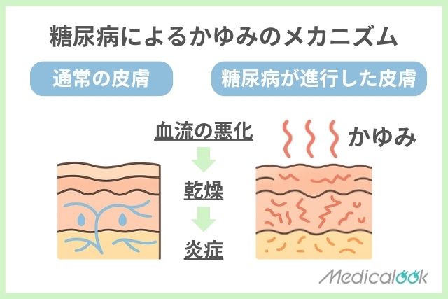 かゆみのメカニズム