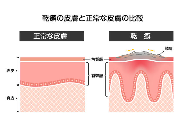 乾癬の皮膚との比較