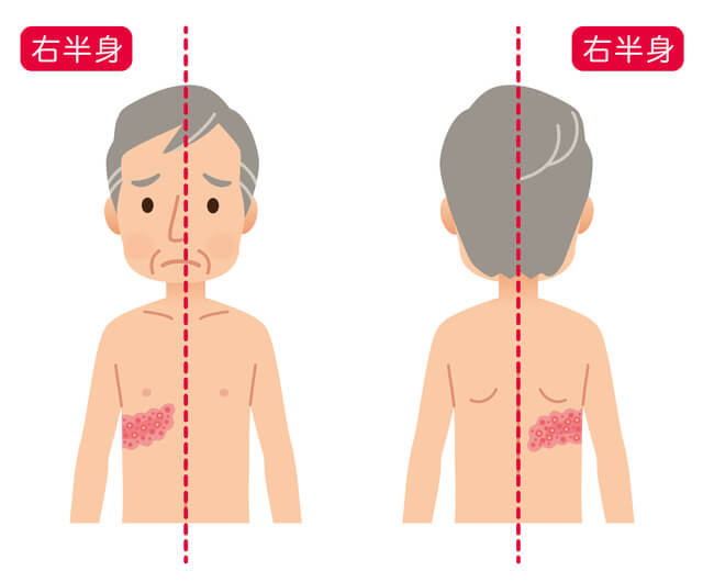 帯状疱疹の症状