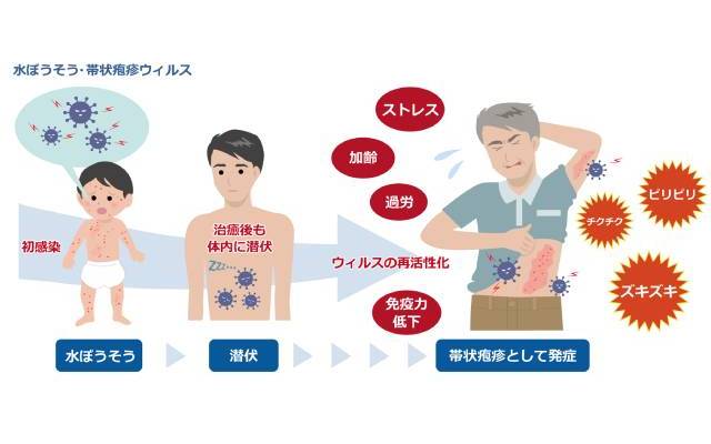 帯状疱疹の原因