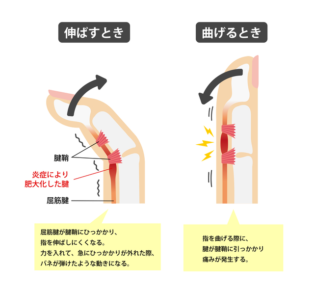 ばね指（指の腱鞘炎）