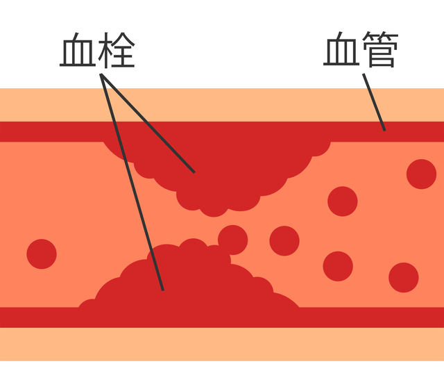 血栓症