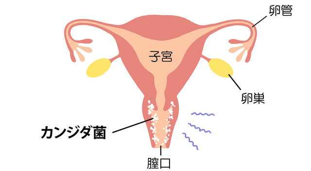 カンジダ症