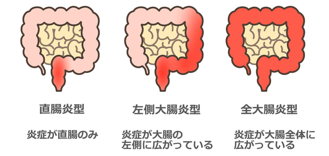 潰瘍性大腸炎