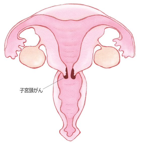 子宮頸ガン