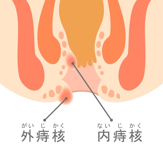 「外痔核」と「内痔核」