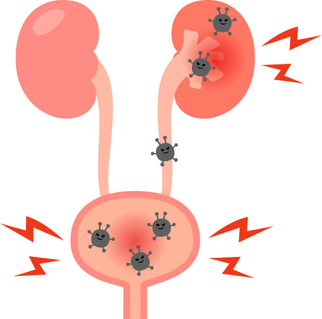 腎盂炎のイメージ