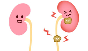 尿管結石の痛みを和らげる姿勢|痛み止めは使える?石を早く出す方法は? | Medicalook(メディカルック)