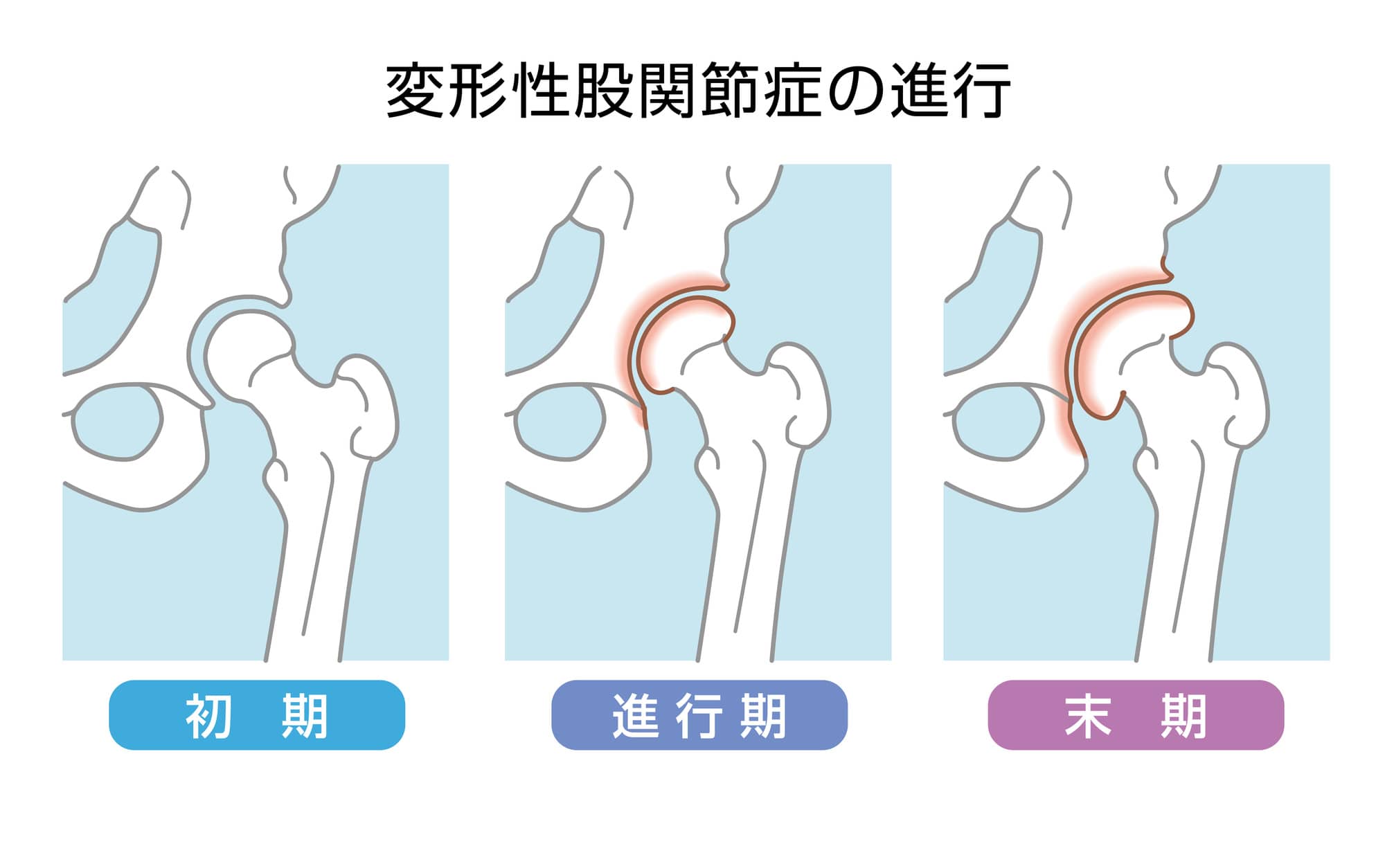 変形性股関節症の進行